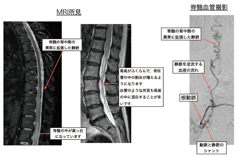 脳・脊髄動静脈奇形と頭蓋内・脊髄硬膜動静脈瘻 - その他