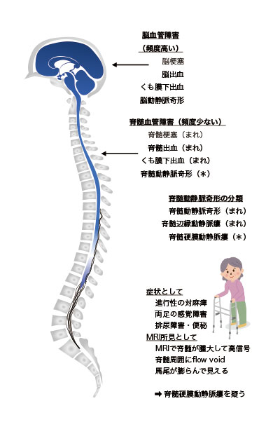 脳・脊髄動静脈奇形と頭蓋内・脊髄硬膜動静脈瘻 - その他