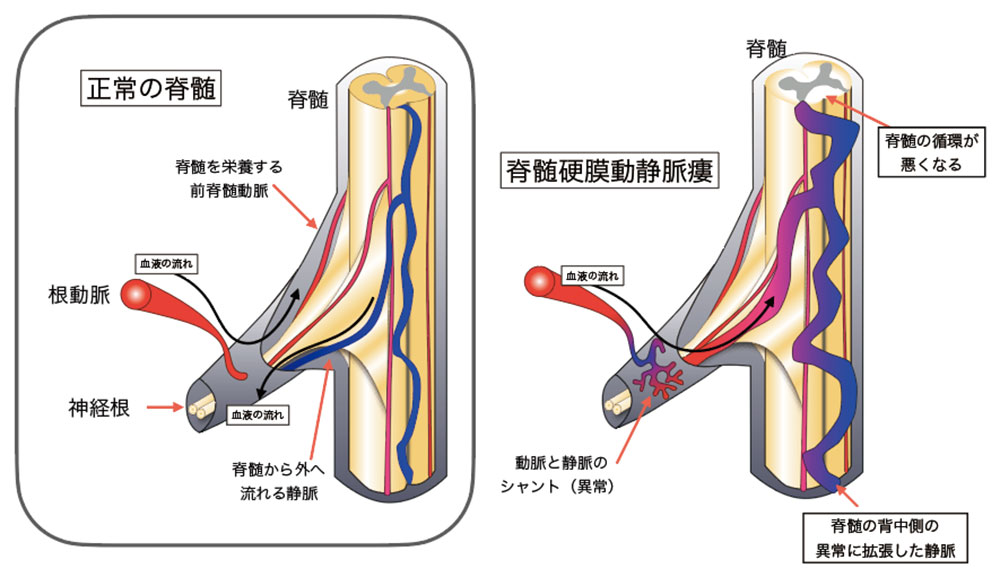 脳・脊髄動静脈奇形と頭蓋内・脊髄硬膜動静脈瘻 - その他